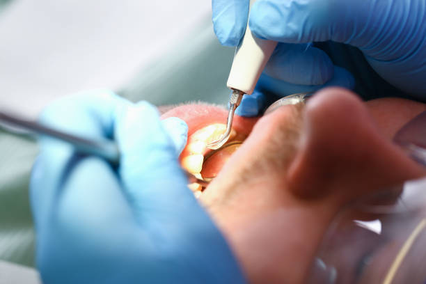 Best Emergency Root Canal Treatment in Parkville, MD